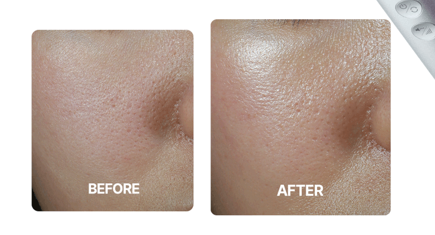 Centellian24 - Madeca Prime Max (Hyper Lifting & Firming Beauty Device)