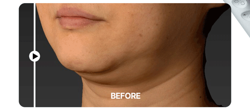 Centellian24 - Madeca Prime Max (Hyper Lifting & Firming Beauty Device)