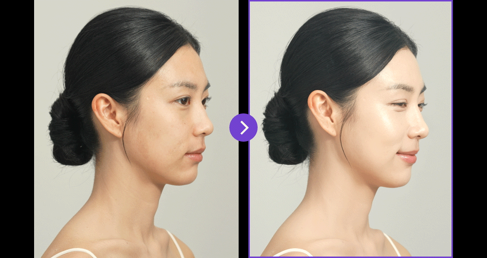 EOA - FULTENZA Premium Lifting Beauty Device [New Launch!]