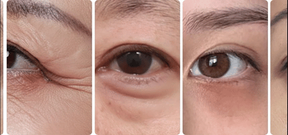 BEAUND - Eye Rejuve (Eye Care Device) [New Launch!]