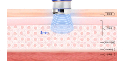 OLLIVIA - The Orlier S1 Beauty Device (Facial Contour & Lifting Care)
