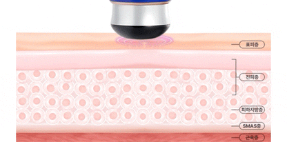 OLLIVIA - The Orlier S1 Beauty Device (Facial Contour & Lifting Care)