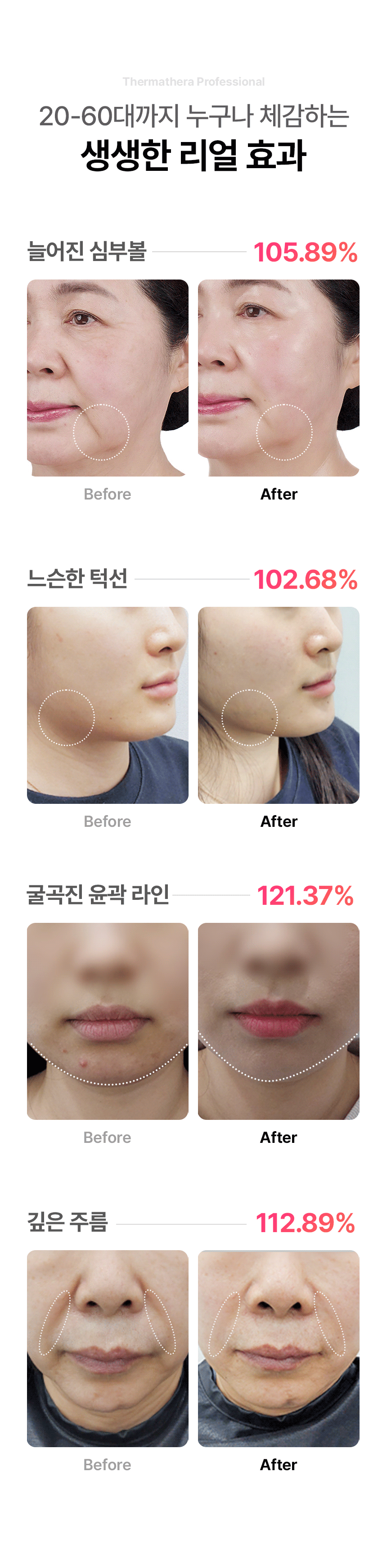 THERMATHERA - Unlimited-Shot HIFU Beauty Device [New Launch!]