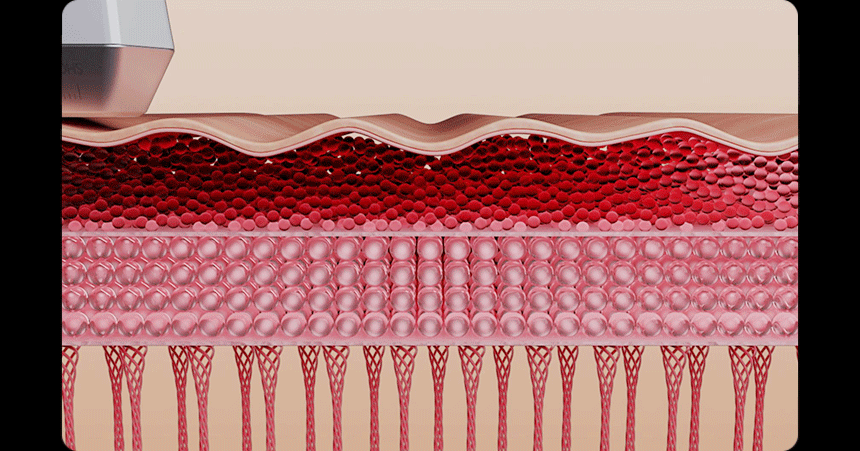 THERMATHERA - Unlimited-Shot HIFU Beauty Device [New Launch!]