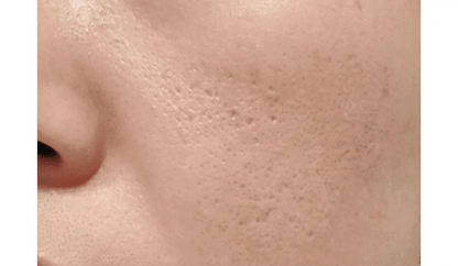 VUDE - Ultra-Low Molecular Diva Shot (Pore Care Beauty Device)