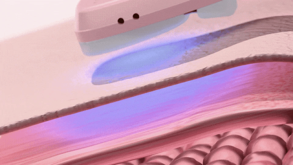 HONBODY - Nose Tune (Beauty Device)