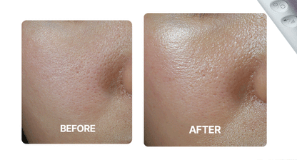 Centellian24 - Madeca Prime Max (Hyper Lifting & Firming Beauty Device)