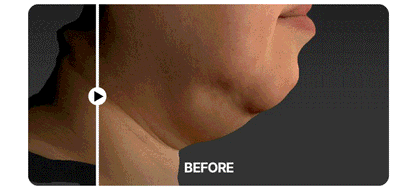 Centellian24 - Madeca Prime Max (Hyper Lifting & Firming Beauty Device)