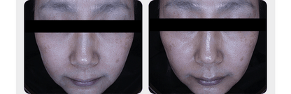 Medicube - Booster Pro Mini Plus