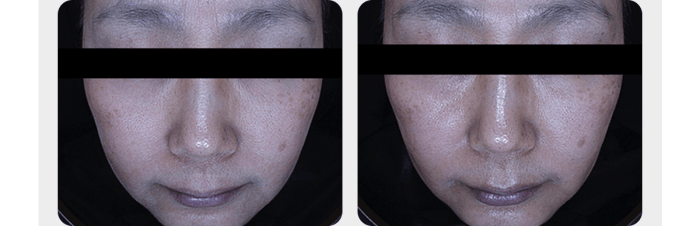 Medicube - Booster Pro Mini Plus